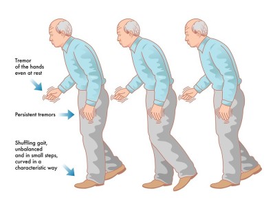 Một số điều cần biết về bệnh Parkinson